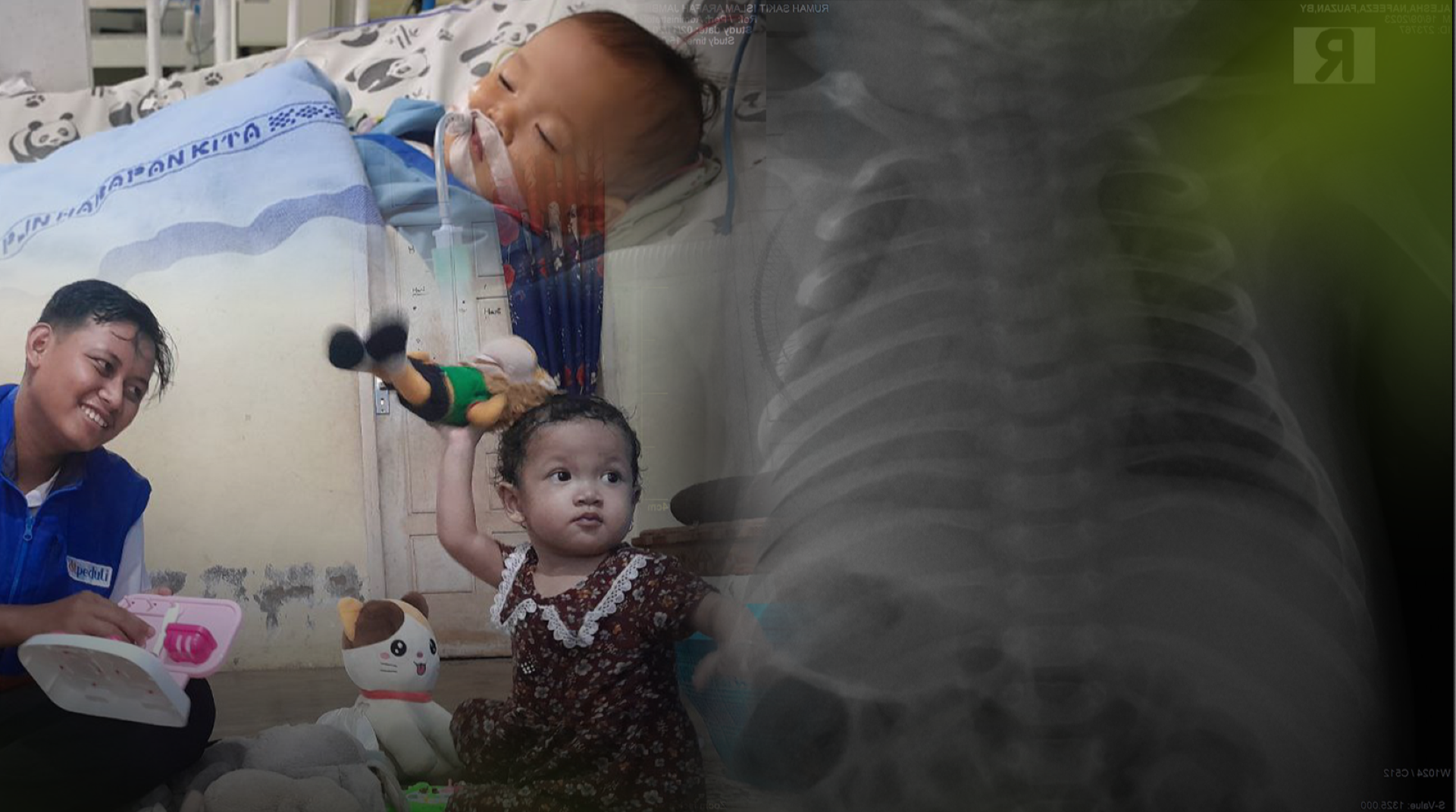 Jantung Bocor Sejak Lahir, Alesha Butuh Bantuan Segera untuk Bertahan