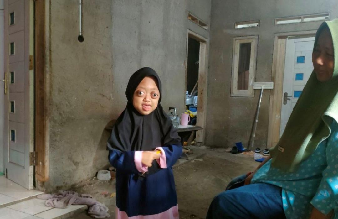 Dua Tahun Terhenti karena Biaya, DT Peduli Garut Salurkan Bantuan Kesehatan untuk Ananda Alika Penderita Syndrom Crouzon 