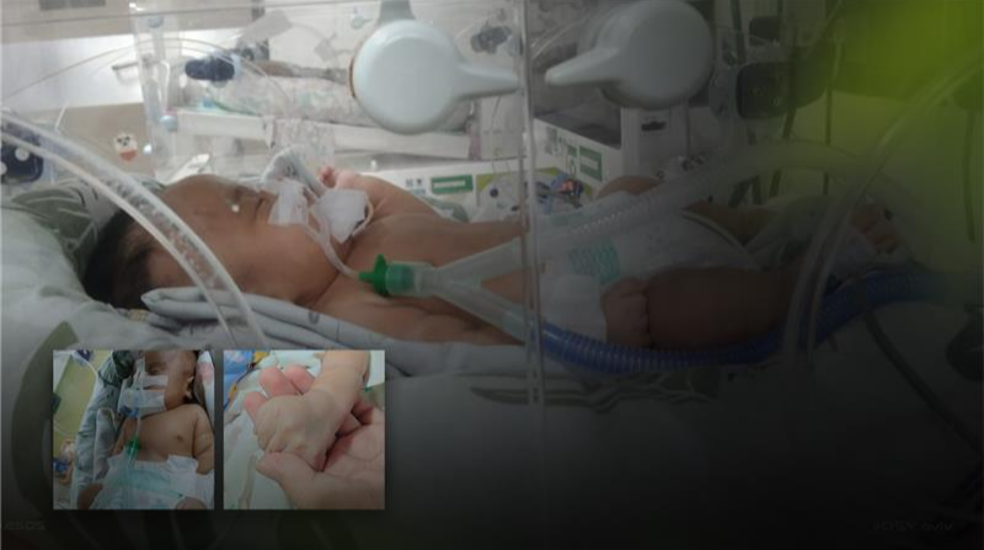 Dari Inkubator ke Ruang Operasi, Bayi 7 Bulan ini Berjuang Melawan Jantung Bocor Sendirian