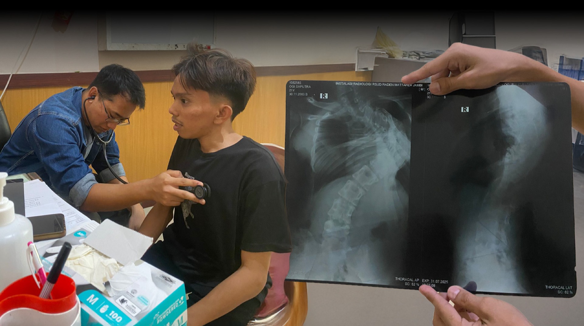 Skoliosis Merenggut Masa Muda, Ogi Butuh Operasi Secepatnya!