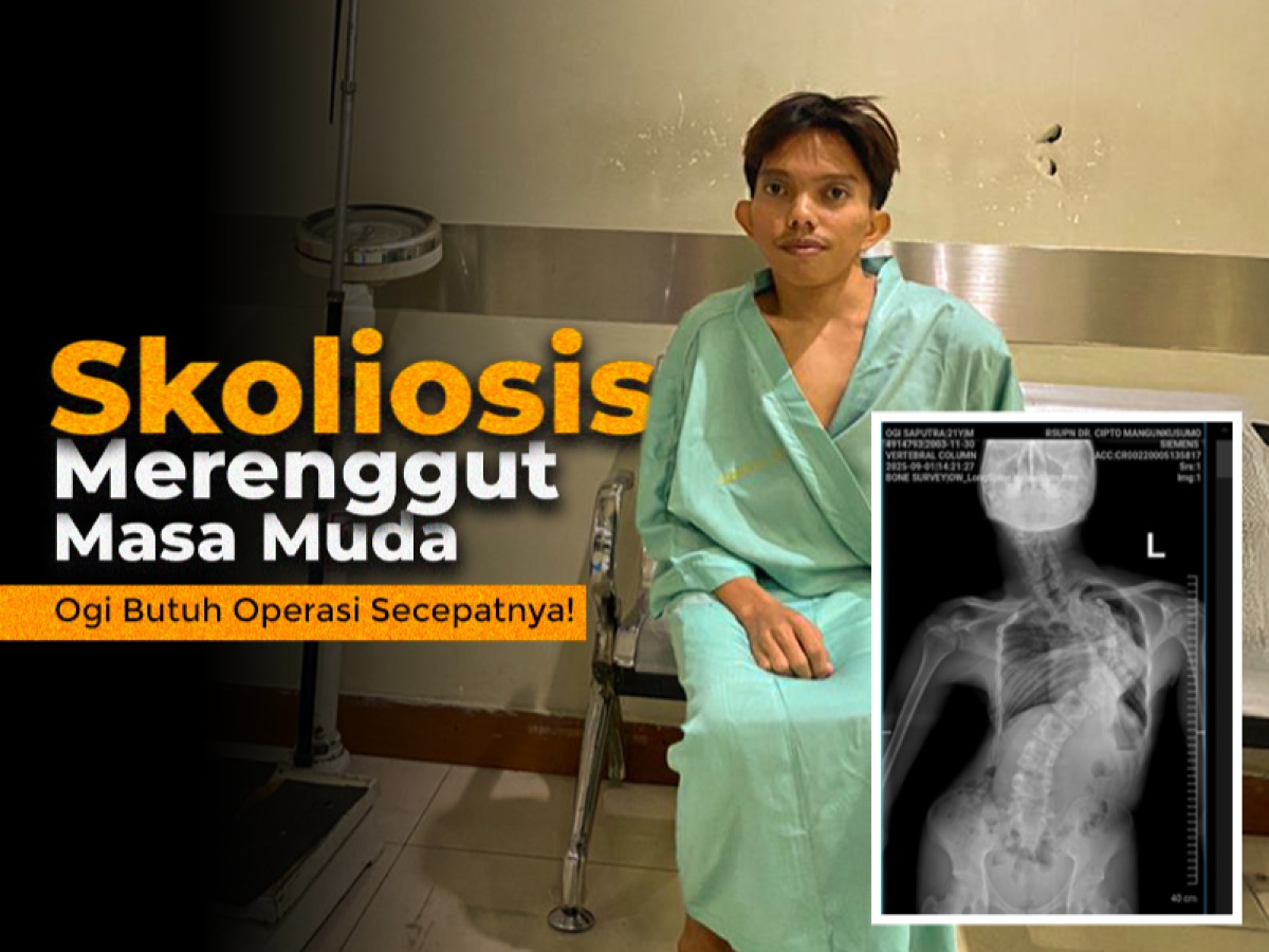 Skoliosis Merenggut Masa Muda, Ogi Butuh Operasi Secepatnya!