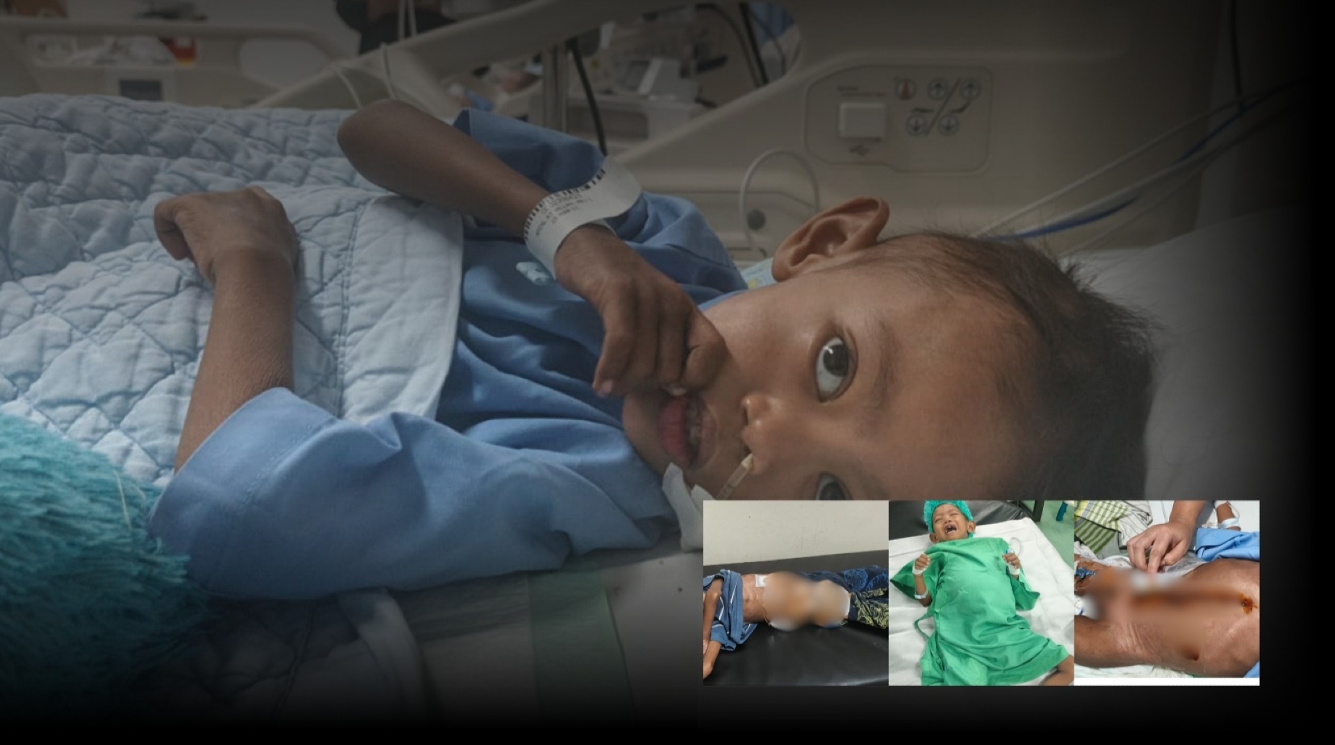 Tumor Wilms Merenggut Masa Kecil Afzal, Temani Perjuangannya untuk Sembuh